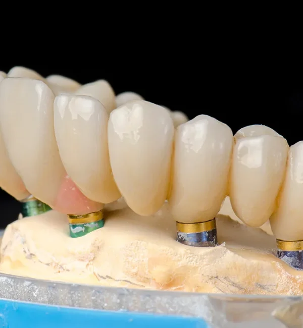 69de67ac47c9a80a7f42e518_service-thumbnail-all-on-4-implants