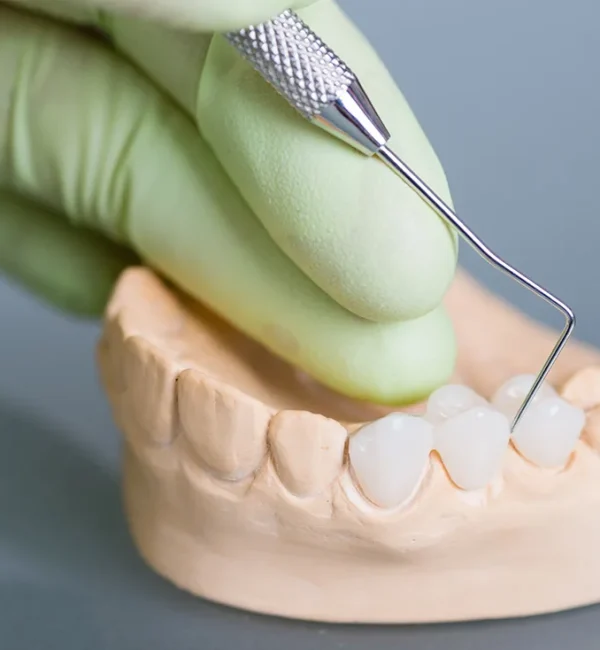 69de67be47c9a80a7f42e9da_service-thumbnail-dental-bridges