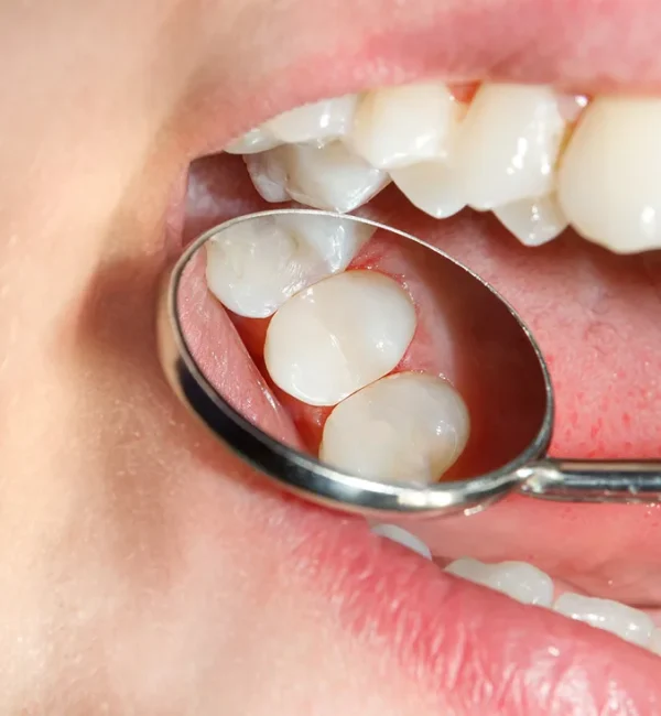 69de67c247c9a80a7f42eb81_service-thumbnail-dental-fillings