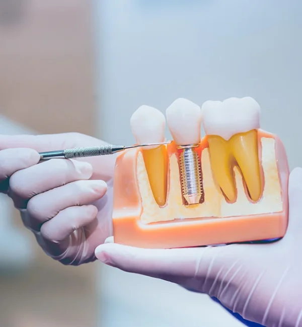 69de67c447c9a80a7f42ebdd_service-thumbnail-dental-implants