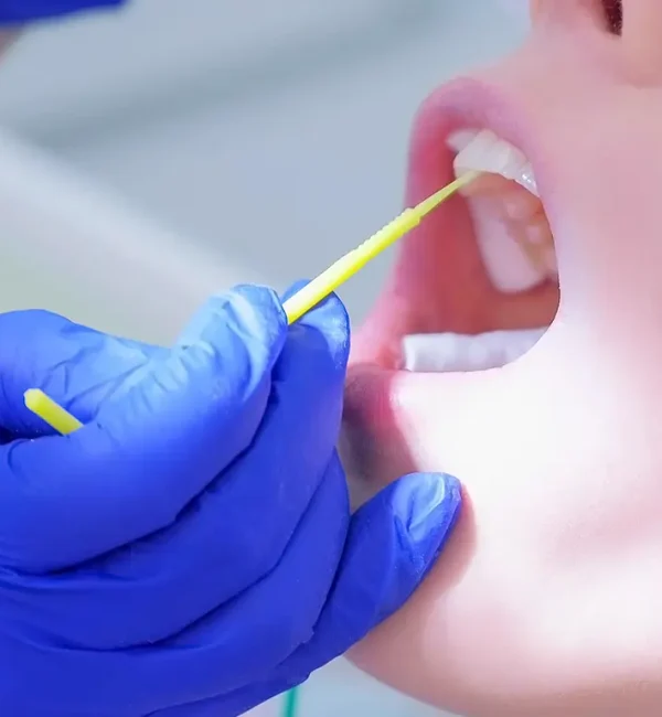 69de67cf47c9a80a7f42ee59_service-thumbnail-fluoride-treatments