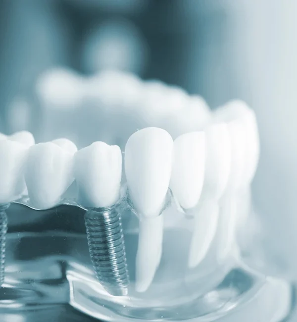 69de67da47c9a80a7f42f072_service-thumbnail-implant-maintenance