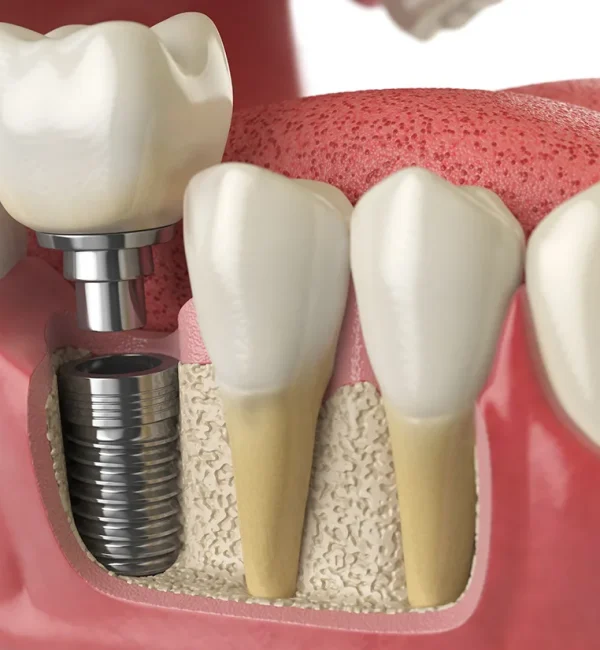 69de67dc47c9a80a7f42f0f1_service-thumbnail-implant-restoration
