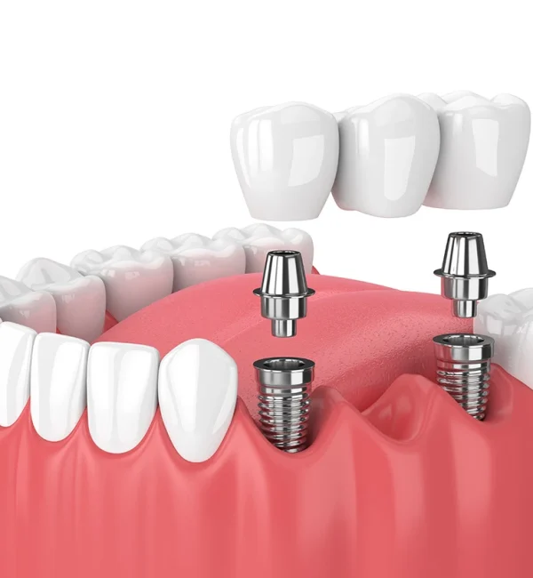 69de67e147c9a80a7f42f275_service-thumbnail-implant-supported-bridges