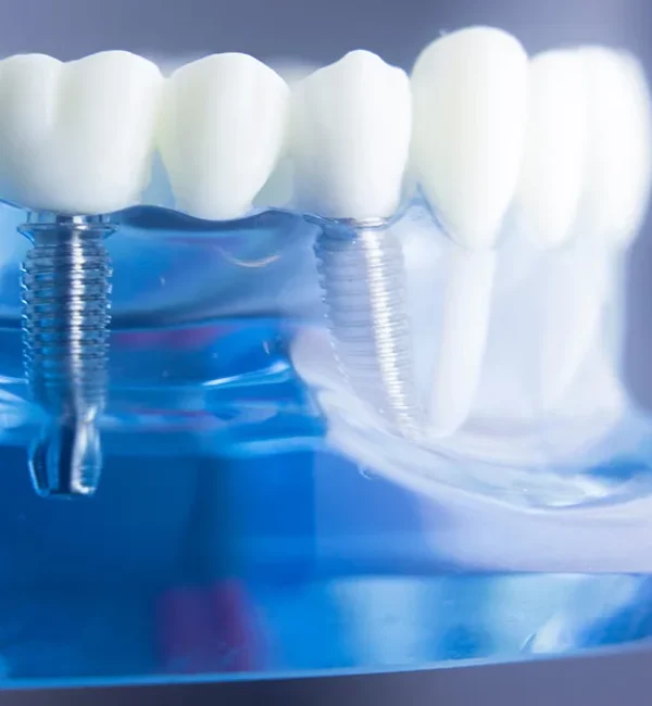 69de67fe47c9a80a7f42faf5_service-thumbnail-single-tooth-implants