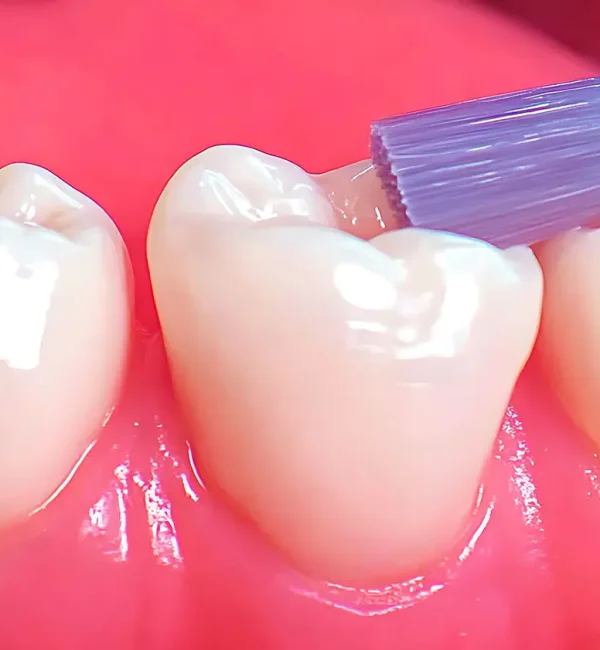 69de681a47c9a80a7f43019c_service-thumbnail-dental-sealants